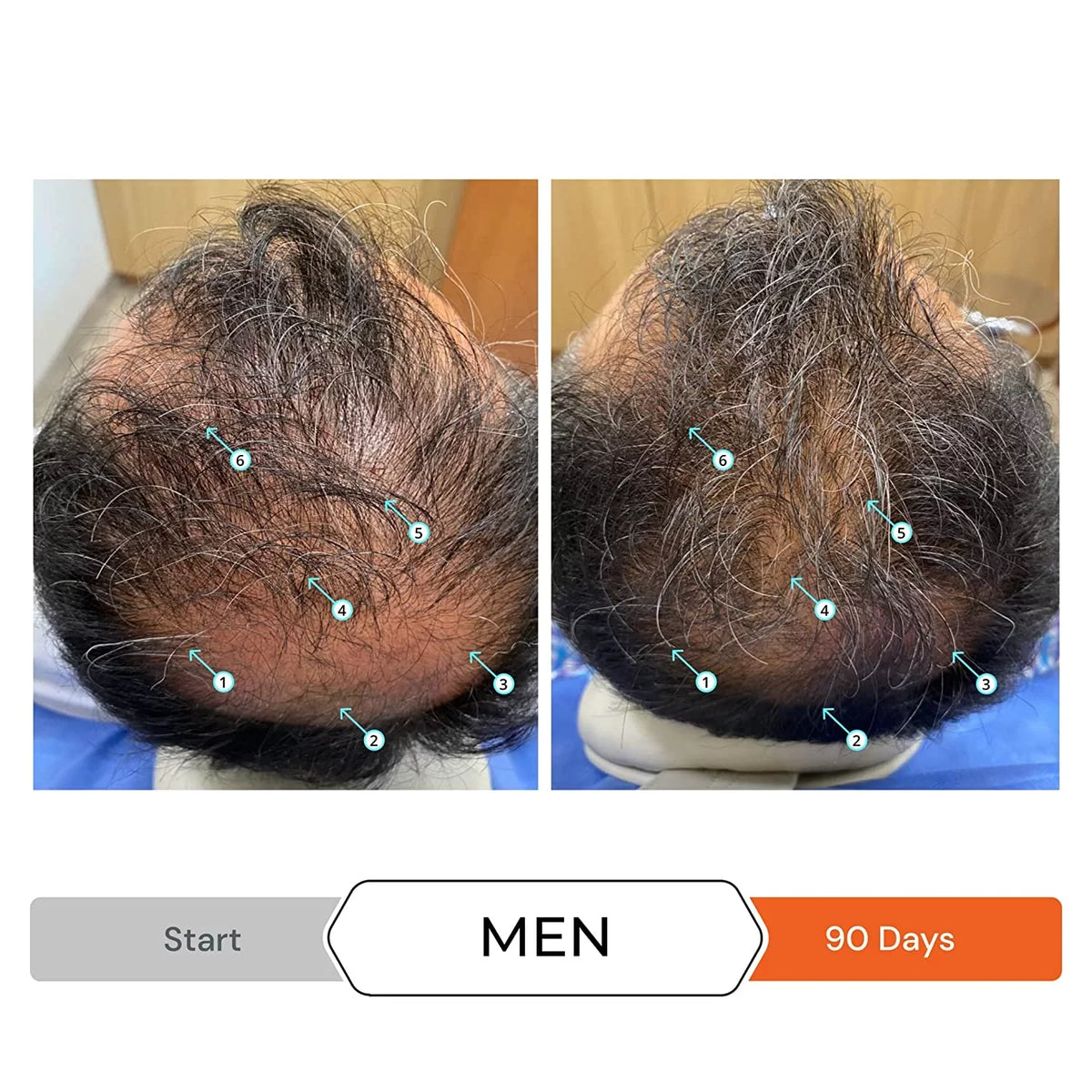Revita Sizehampoo w/Biotin, Caffeine and Hair Growth Sizetimulating Ingredients, Helps Block DHT w/DNC-N Nanoxidil 5% Hair Regrowth Treatment