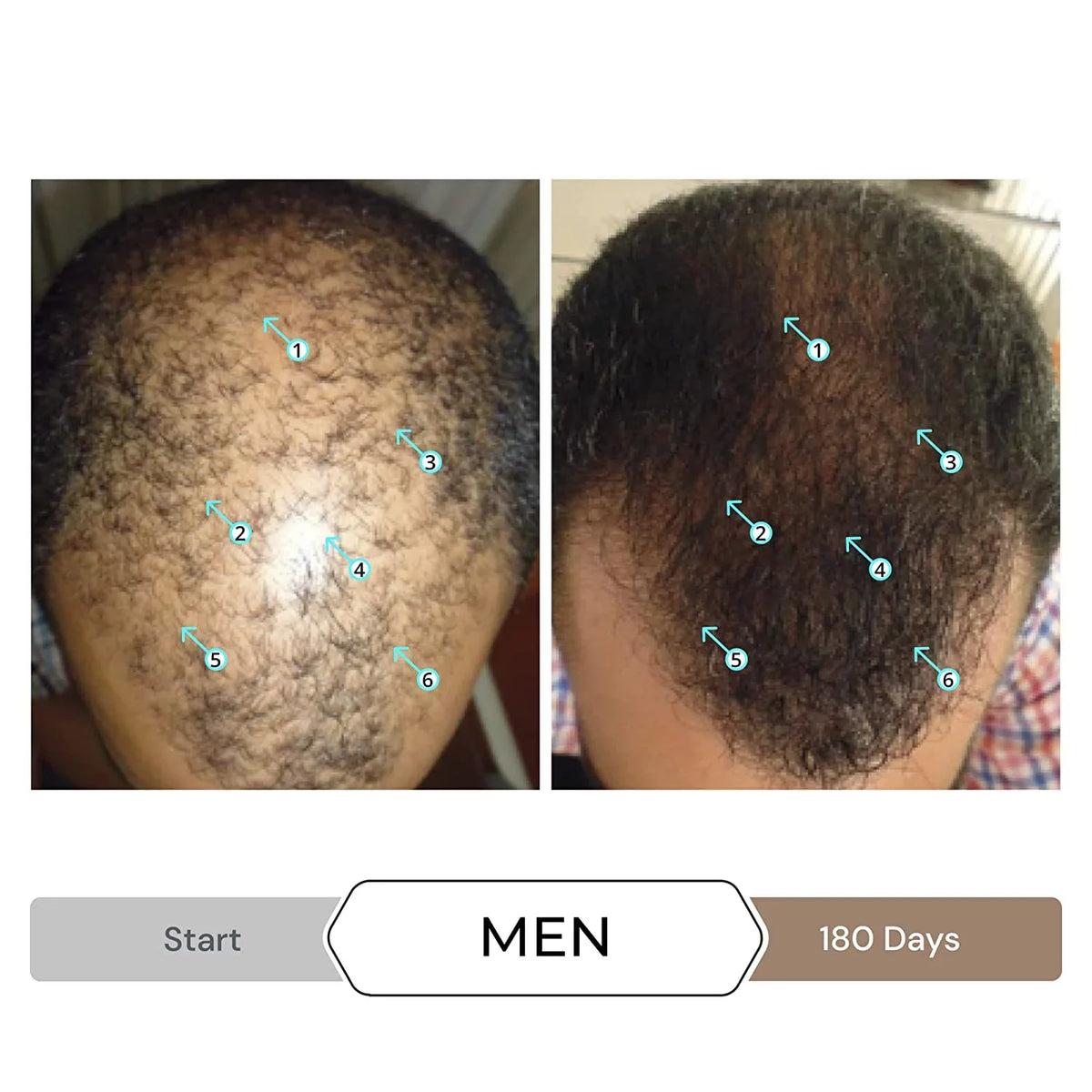 Revita Sizehampoo w/Biotin, Caffeine and Hair Growth Sizetimulating Ingredients, Helps Block DHT w/DNC-N Nanoxidil 5% Hair Regrowth Treatment